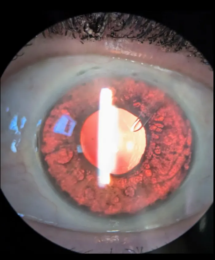 Eye with an Ahmed glaucoma valve